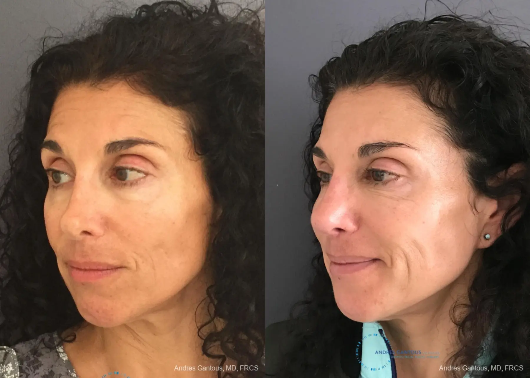 Revision Rhinoplasty: Patient 6 - Before and After 3