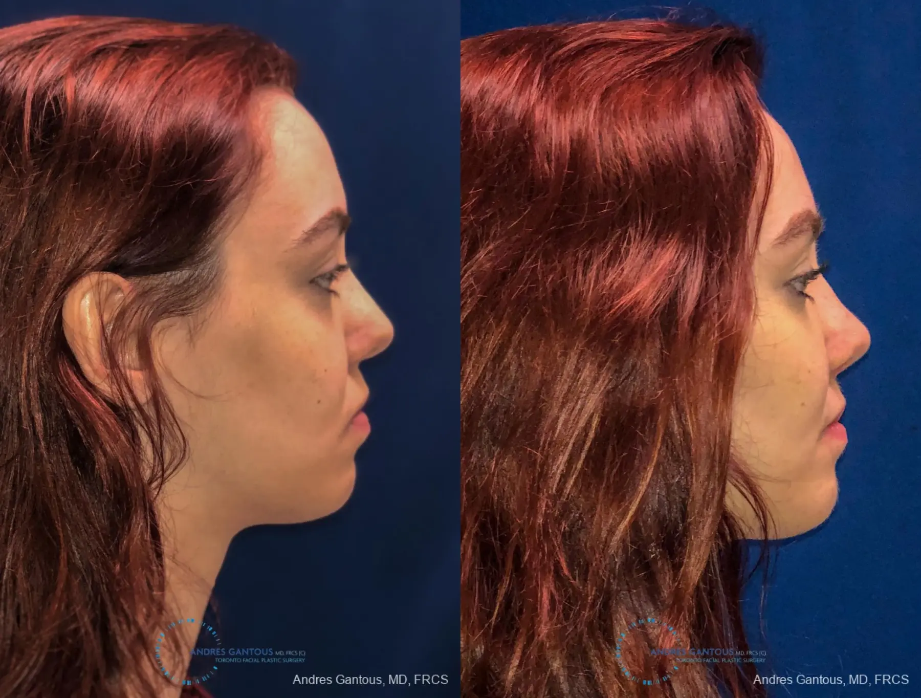 Revision Rhinoplasty: Patient 10 - Before and After 6