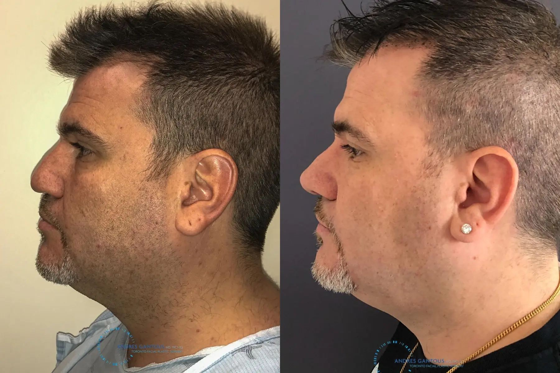 Revision Rhinoplasty: Patient 22 - Before and After 5