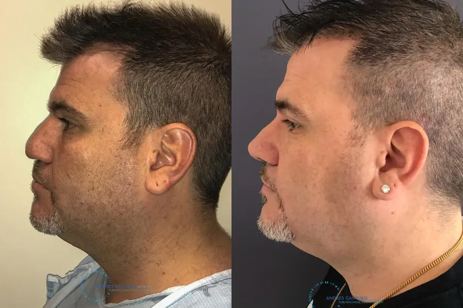 Revision Rhinoplasty: Patient 22 - Before and After 5