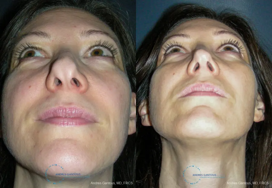Revision Rhinoplasty: Patient 14 - Before and After 2