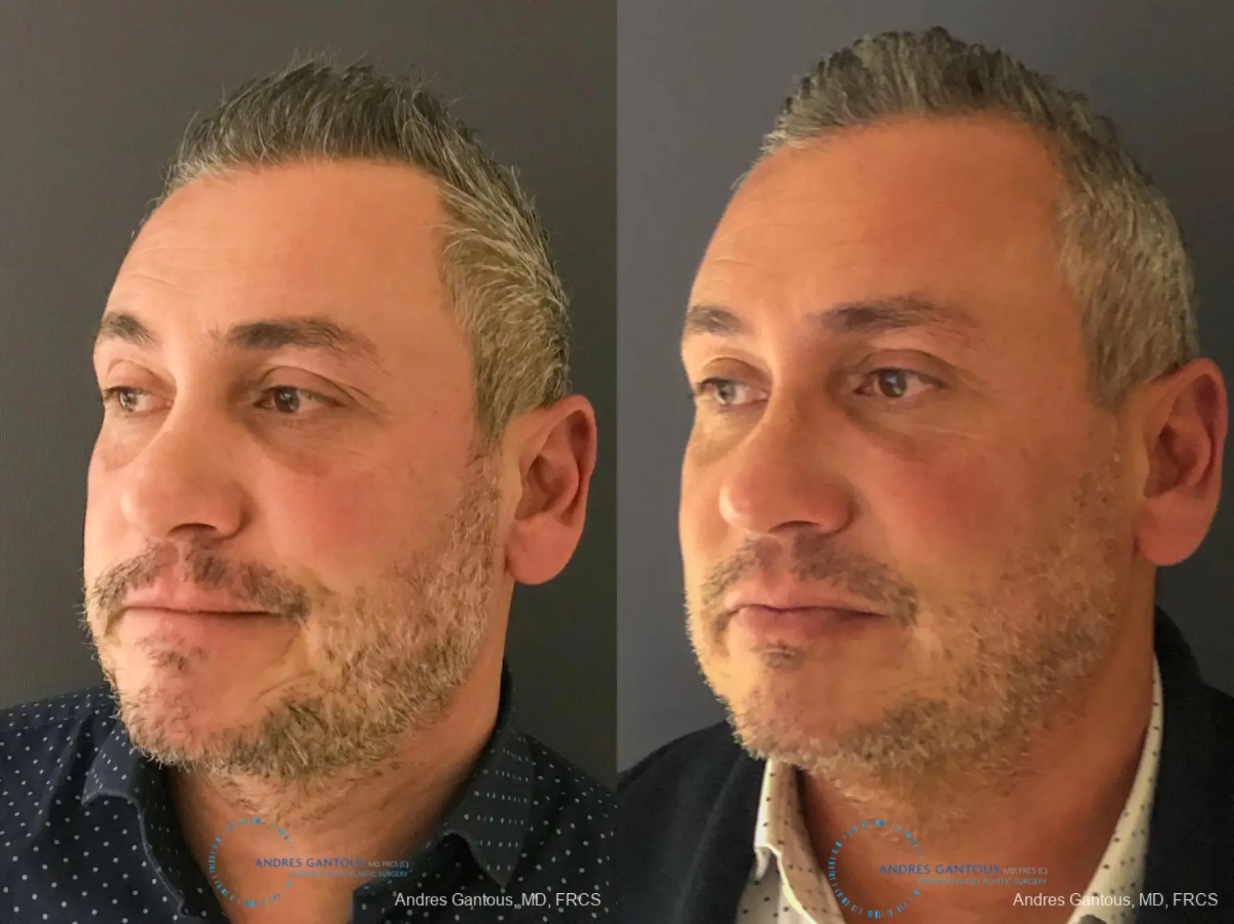 Revision Rhinoplasty: Patient 7 - Before and After 4