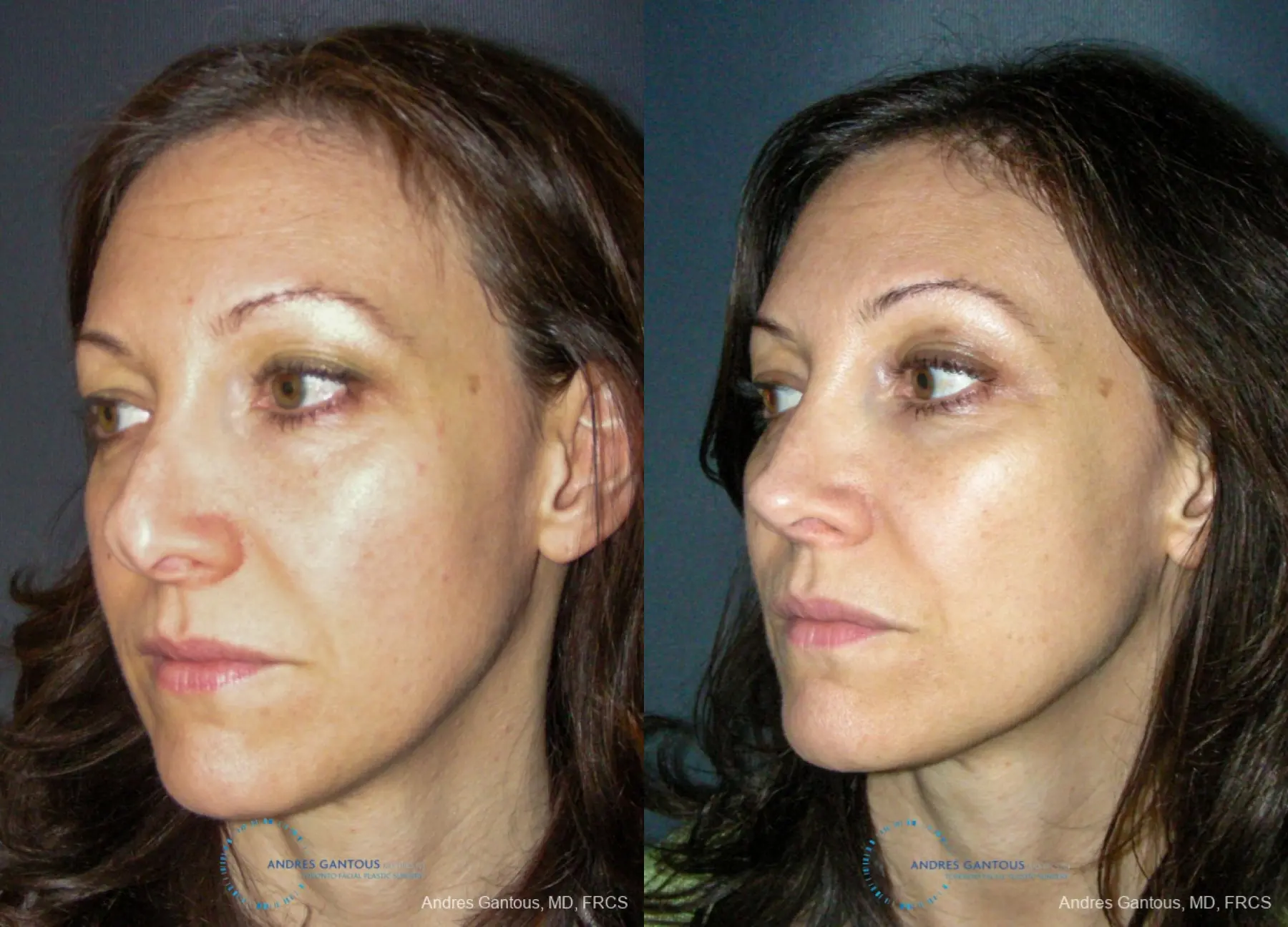 Revision Rhinoplasty: Patient 14 - Before and After 4