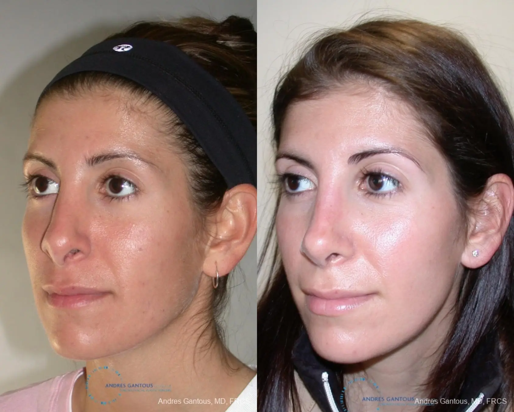 Revision Rhinoplasty: Patient 1 - Before and After 3