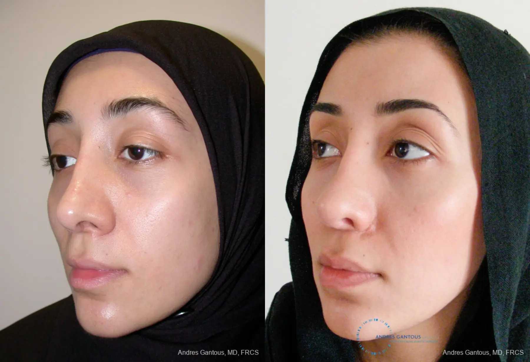 Revision Rhinoplasty: Patient 5 - Before and After 4