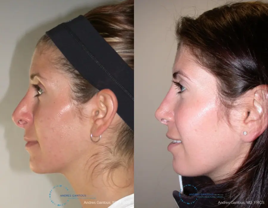 Revision Rhinoplasty: Patient 1 - Before and After 4