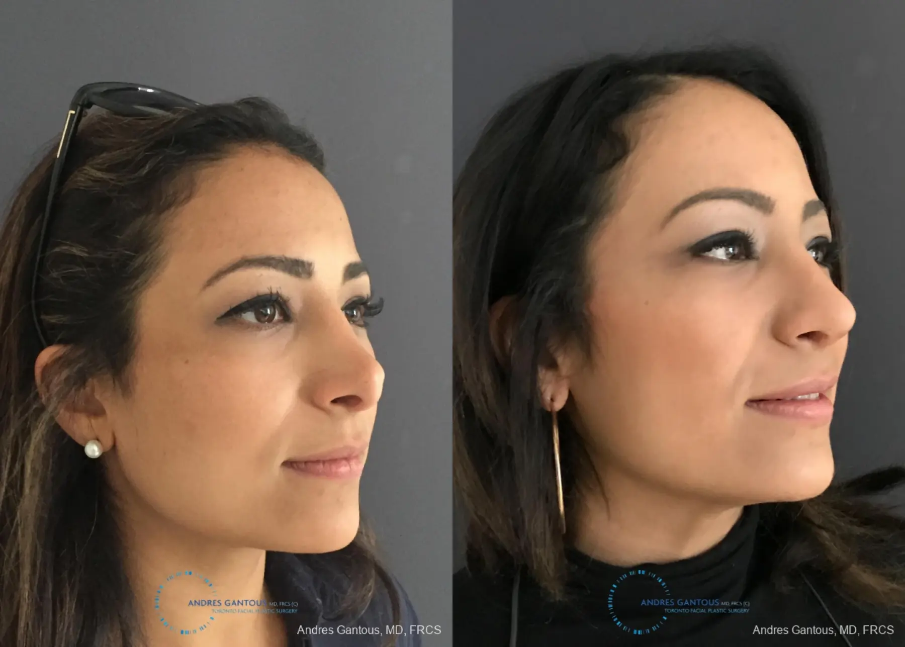 Revision Rhinoplasty: Patient 11 - Before and After 3