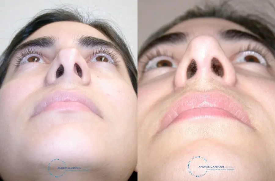 Revision Rhinoplasty: Patient 15 - Before and After 2