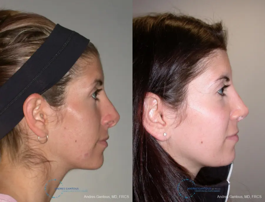 Revision Rhinoplasty: Patient 1 - Before and After 5