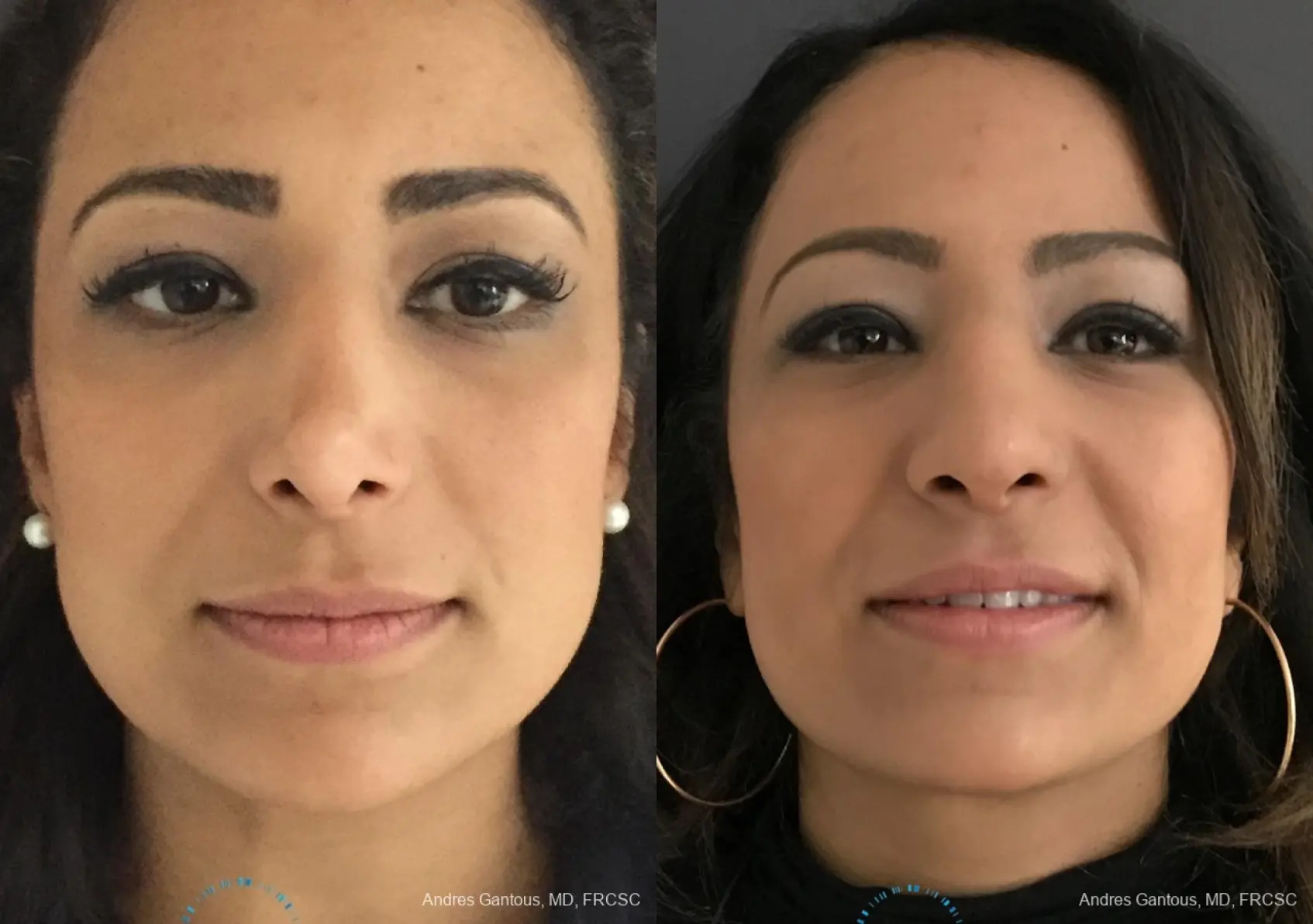 Revision Rhinoplasty: Patient 11 - Before and After  