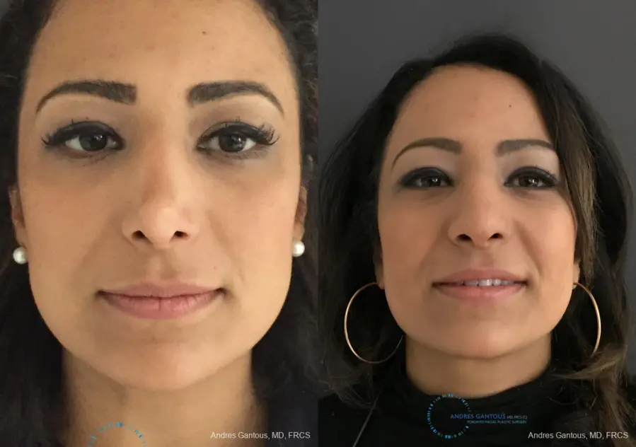 Revision Rhinoplasty: Patient 11 - Before and After 1