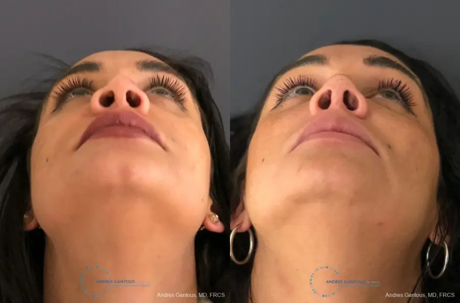 Revision Rhinoplasty: Patient 13 - Before and After 2