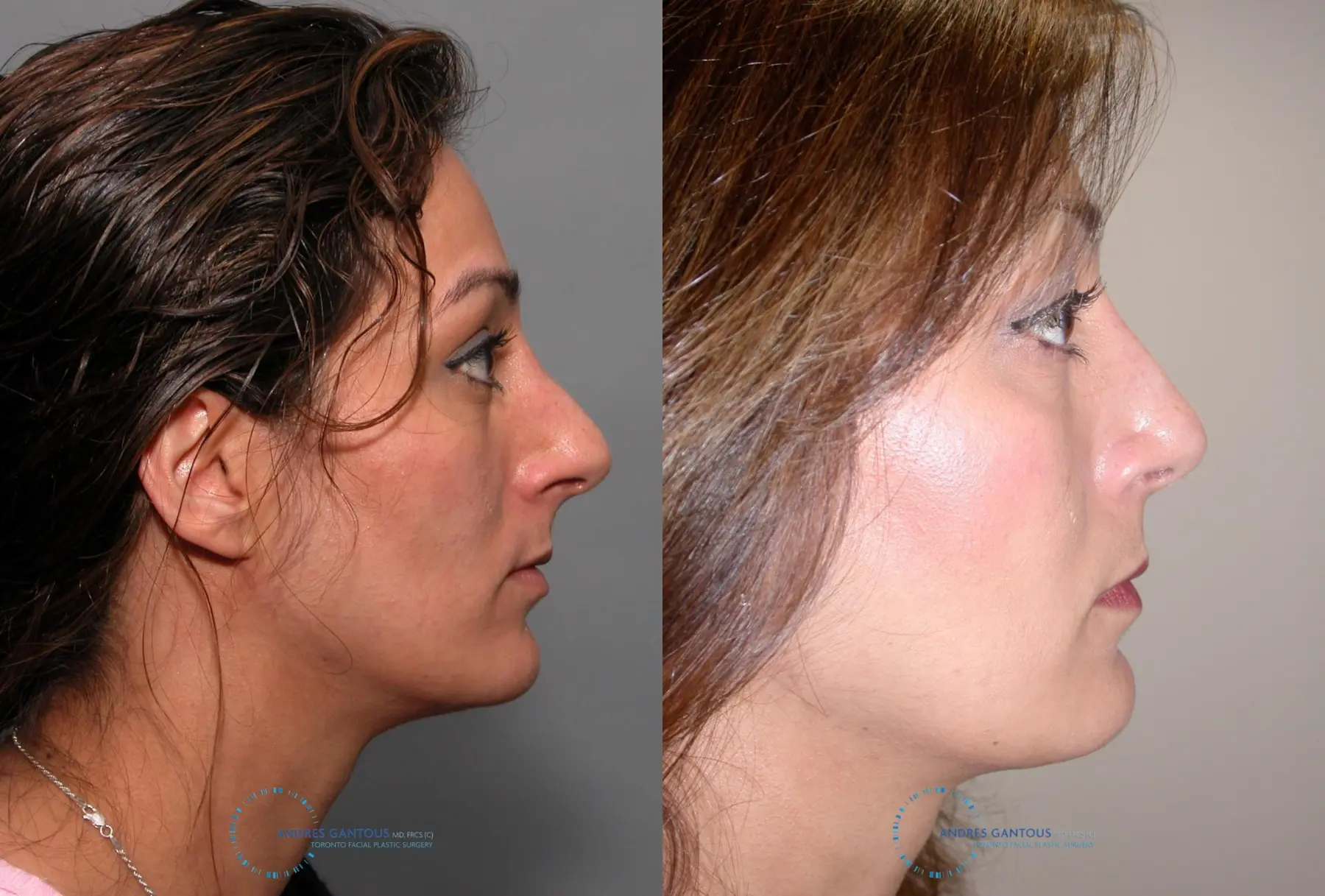 Revision Rhinoplasty: Patient 17 - Before and After 3