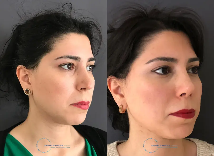 Revision Rhinoplasty: Patient 18 - Before and After 4