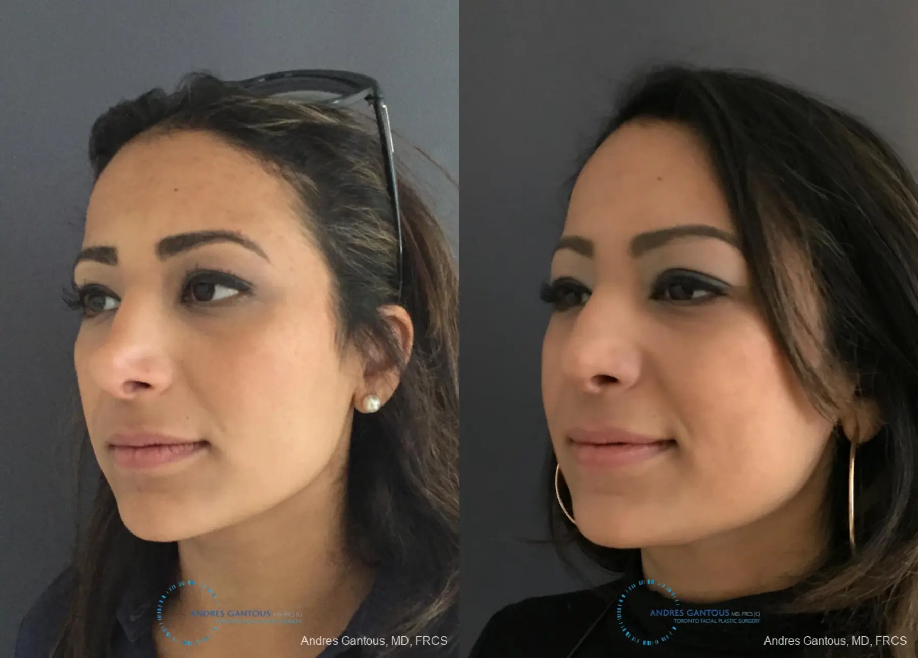Revision Rhinoplasty: Patient 11 - Before and After 4