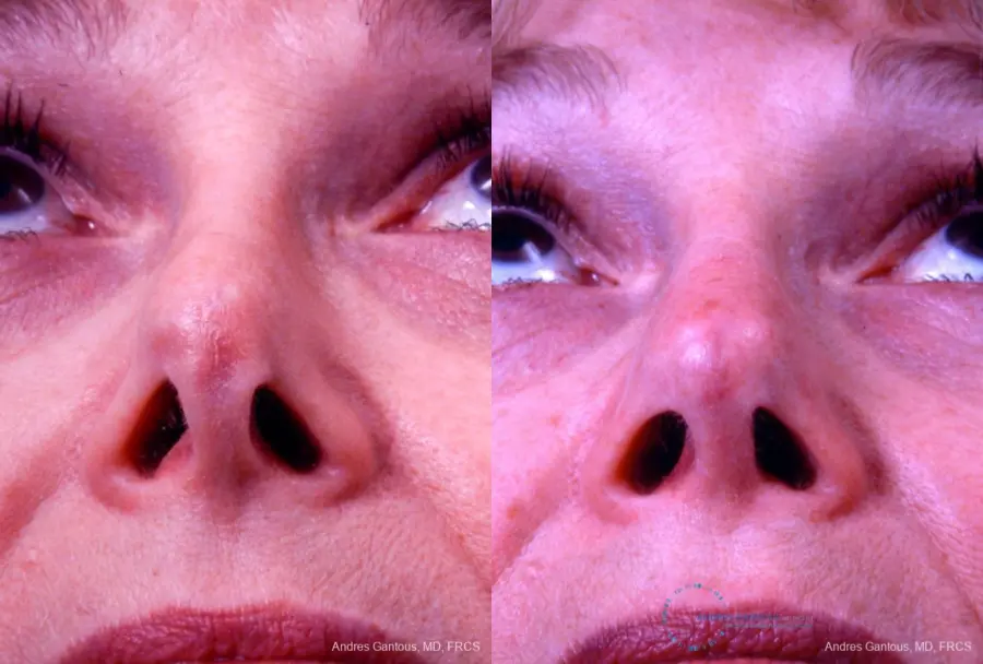 Revision Rhinoplasty: Patient 8 - Before and After 2