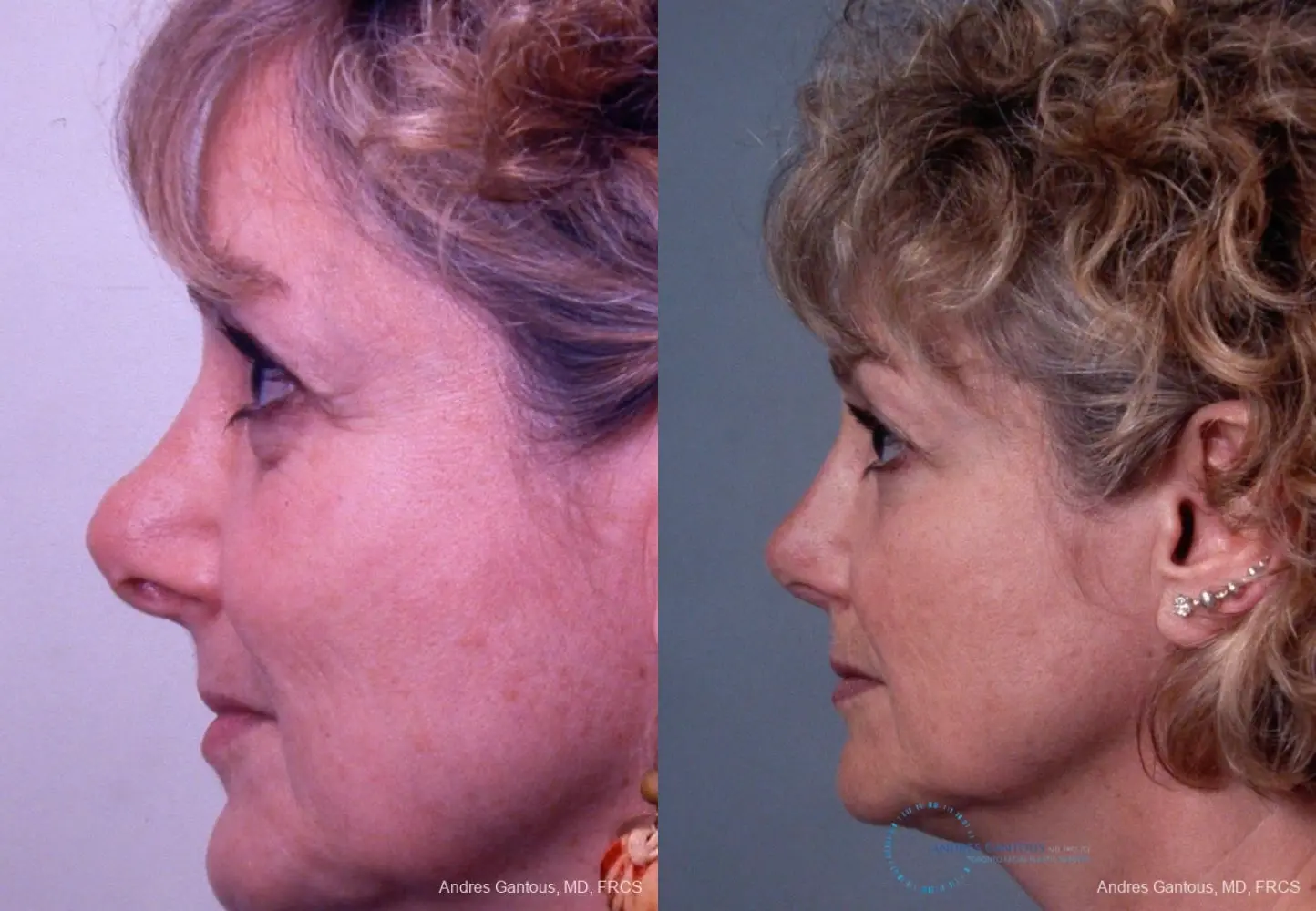 Revision Rhinoplasty: Patient 8 - Before and After 6