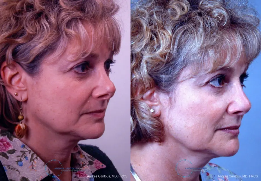 Revision Rhinoplasty: Patient 8 - Before and After 3