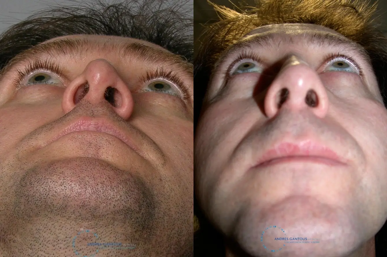 Revision Rhinoplasty: Patient 20 - Before and After 2
