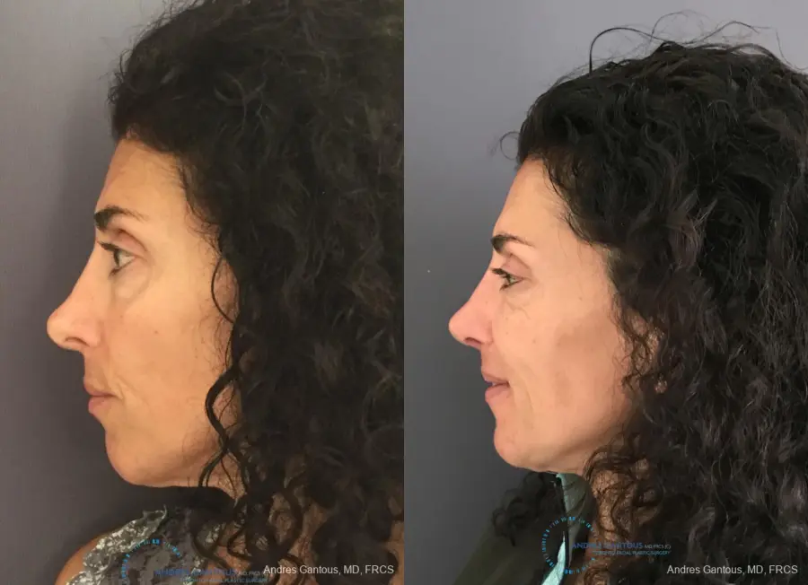 Revision Rhinoplasty: Patient 6 - Before and After 5
