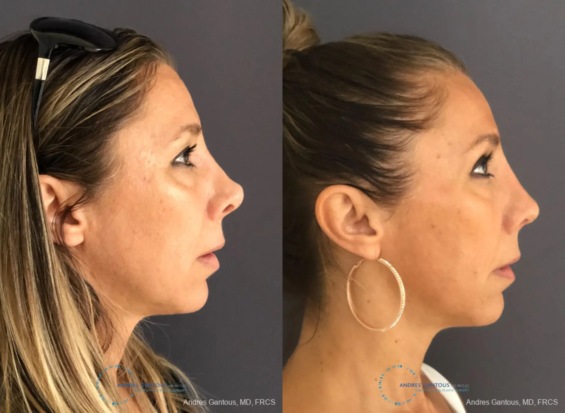 Revision Rhinoplasty: Patient 3 - Before and After 5