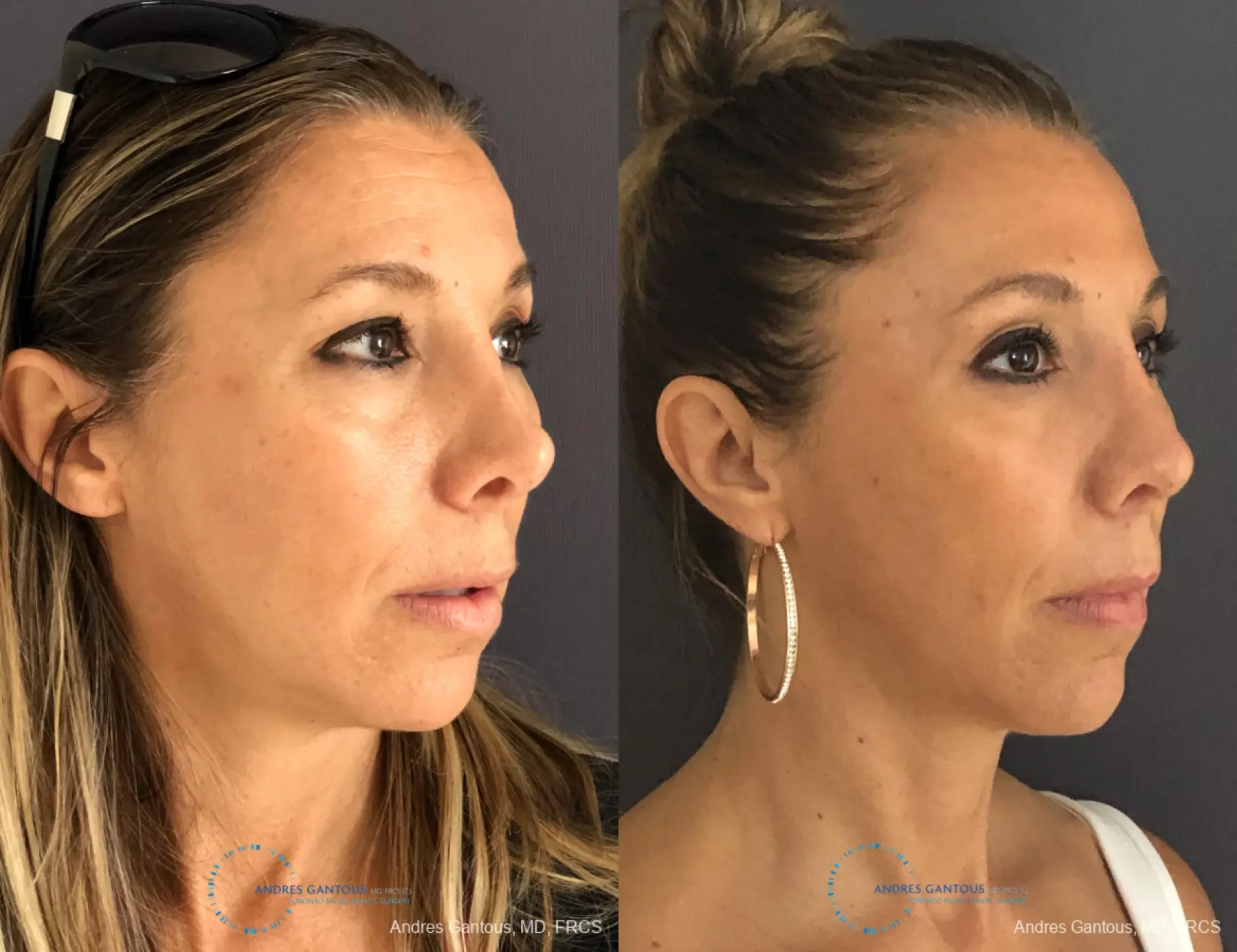 Revision Rhinoplasty: Patient 3 - Before and After 4