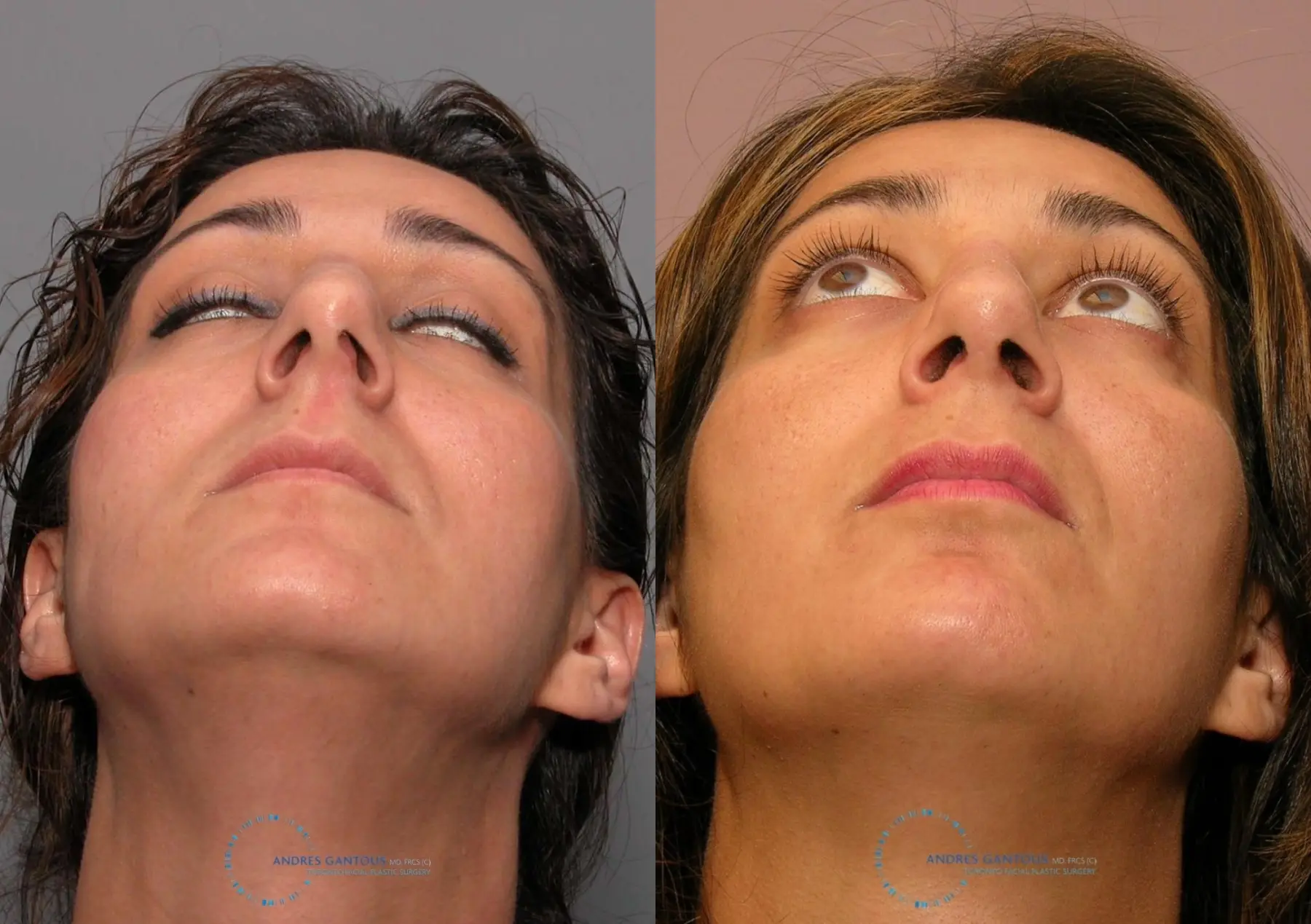 Revision Rhinoplasty: Patient 17 - Before and After 2