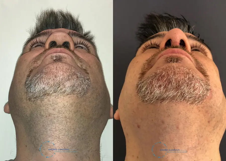 Revision Rhinoplasty: Patient 22 - Before and After 2