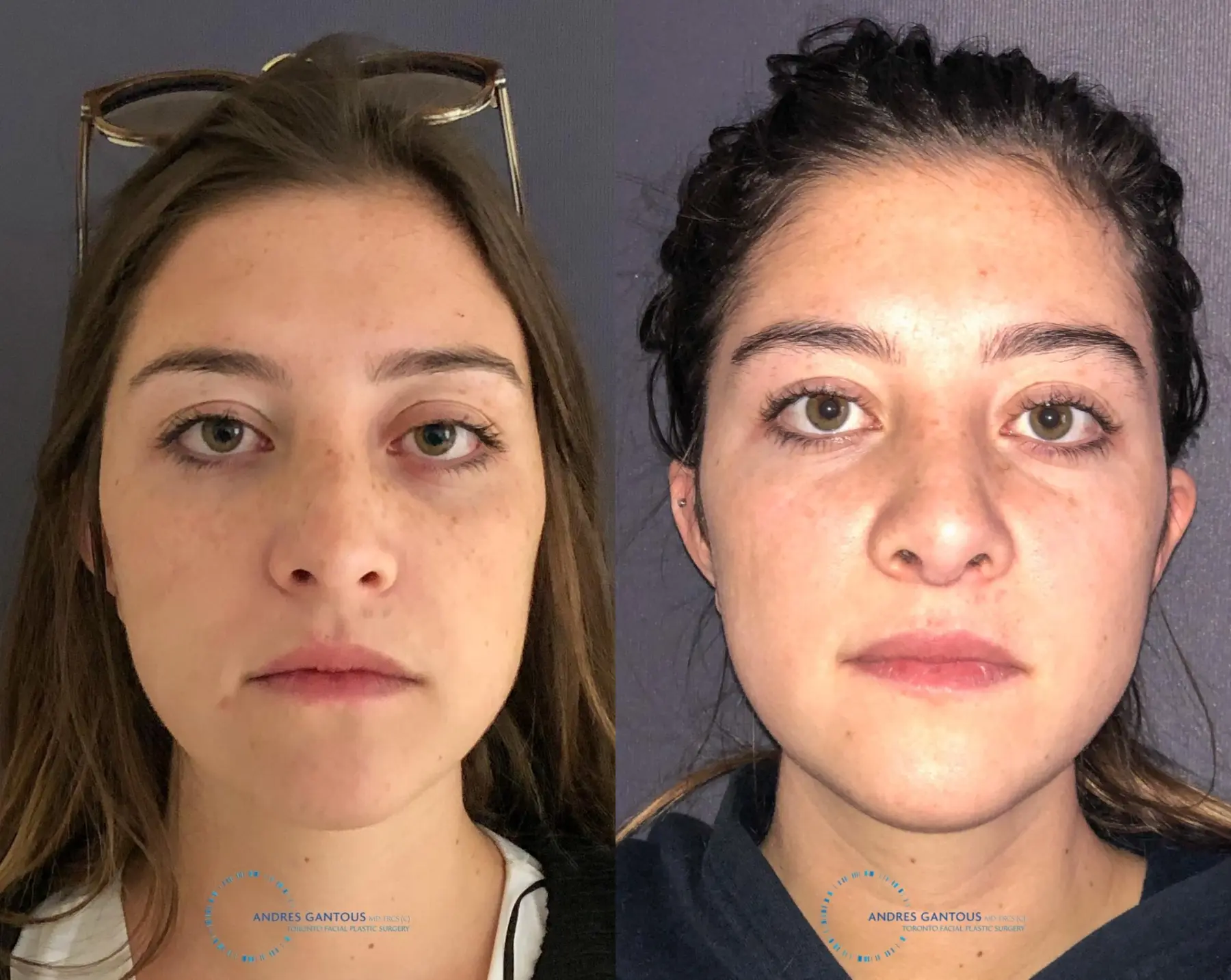 Revision Rhinoplasty: Patient 21 - Before and After 1