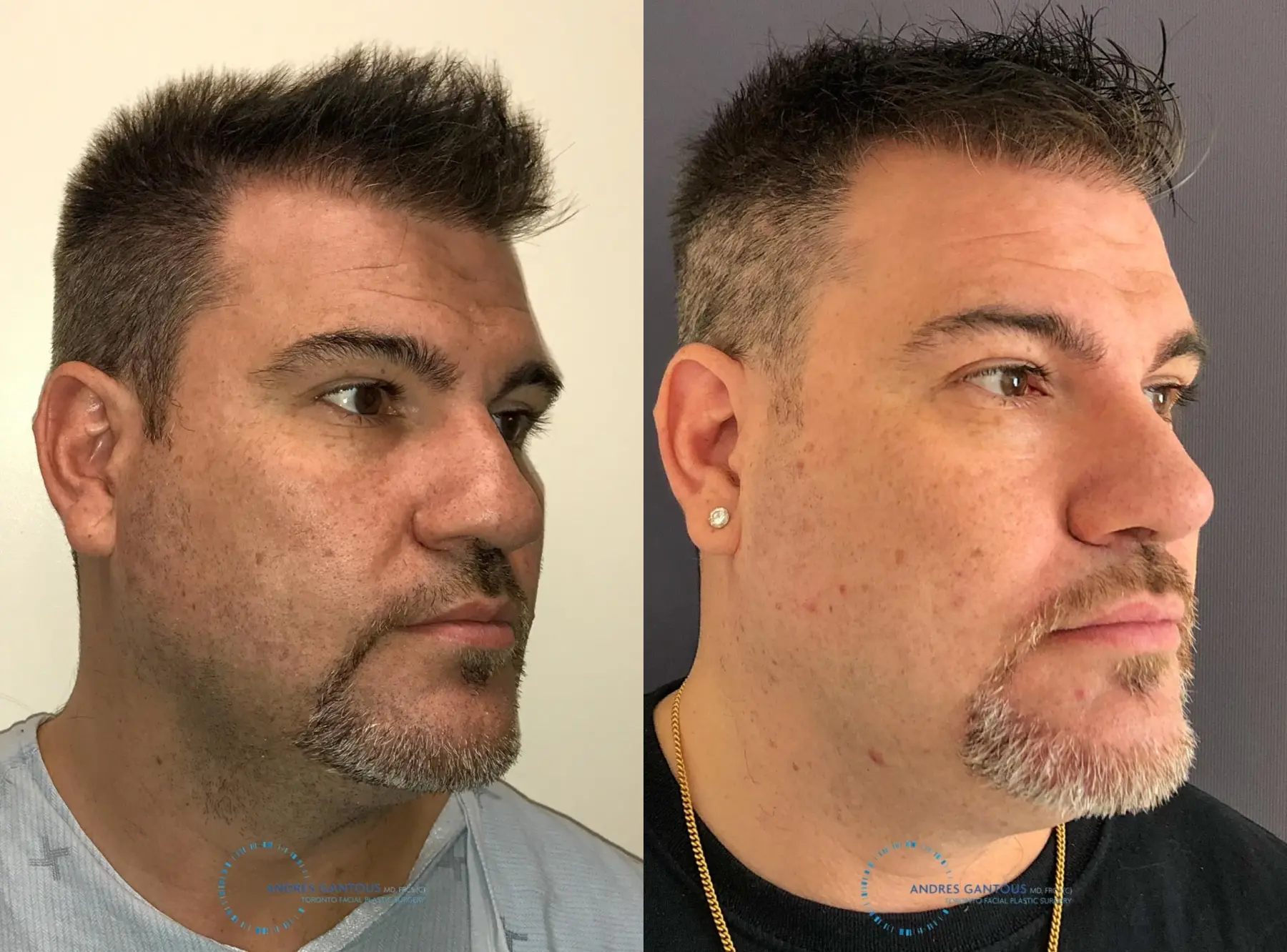 Revision Rhinoplasty: Patient 22 - Before and After 4