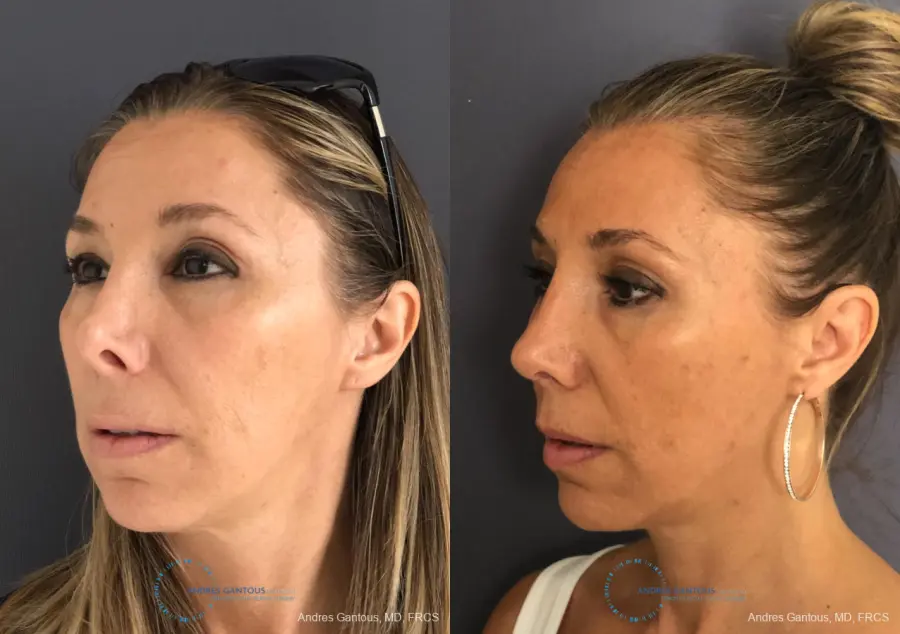 Revision Rhinoplasty: Patient 3 - Before and After 3