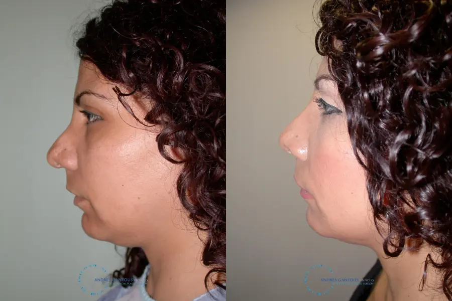 Revision Rhinoplasty: Patient 12 - Before and After 6