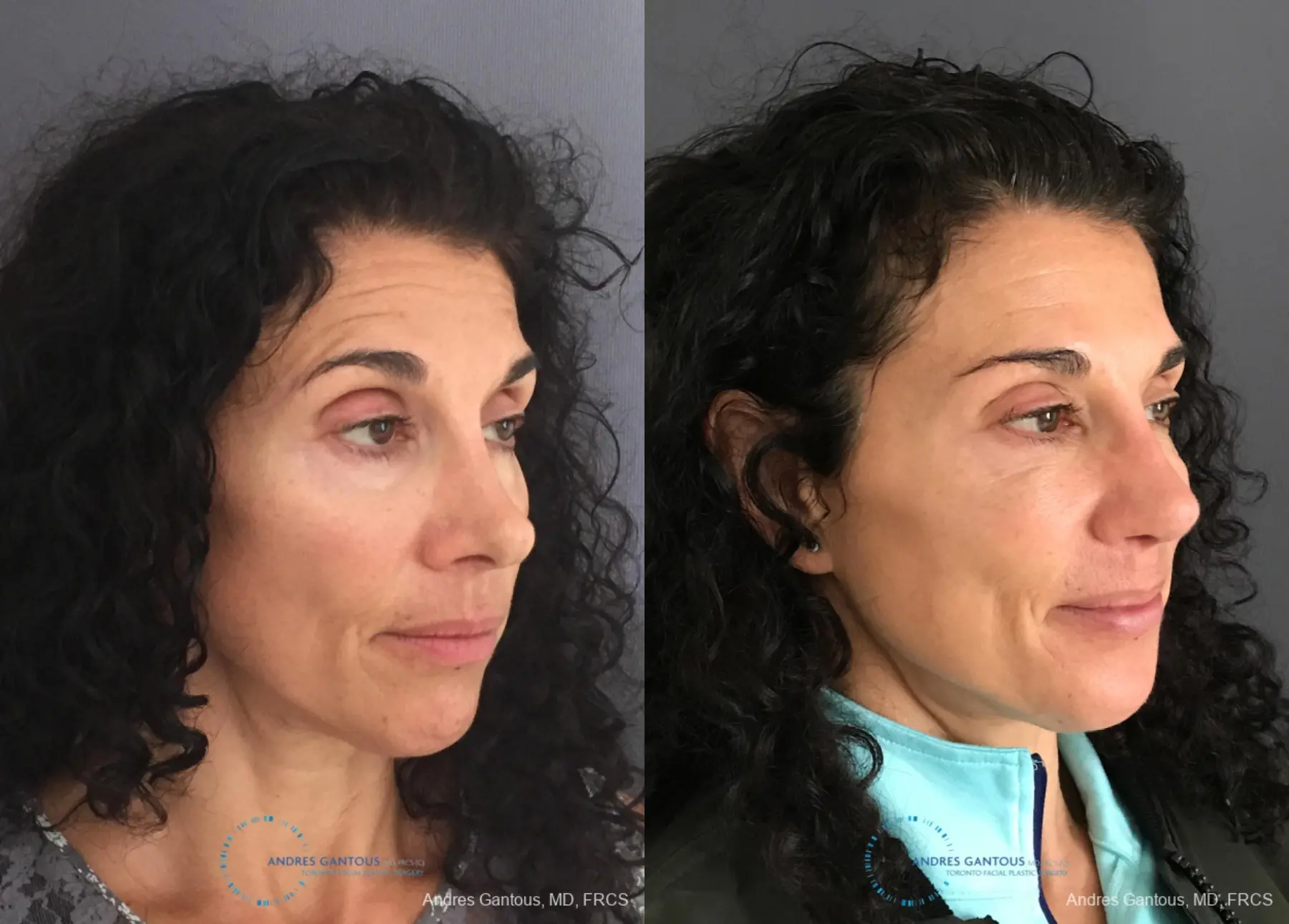 Revision Rhinoplasty: Patient 6 - Before and After 4