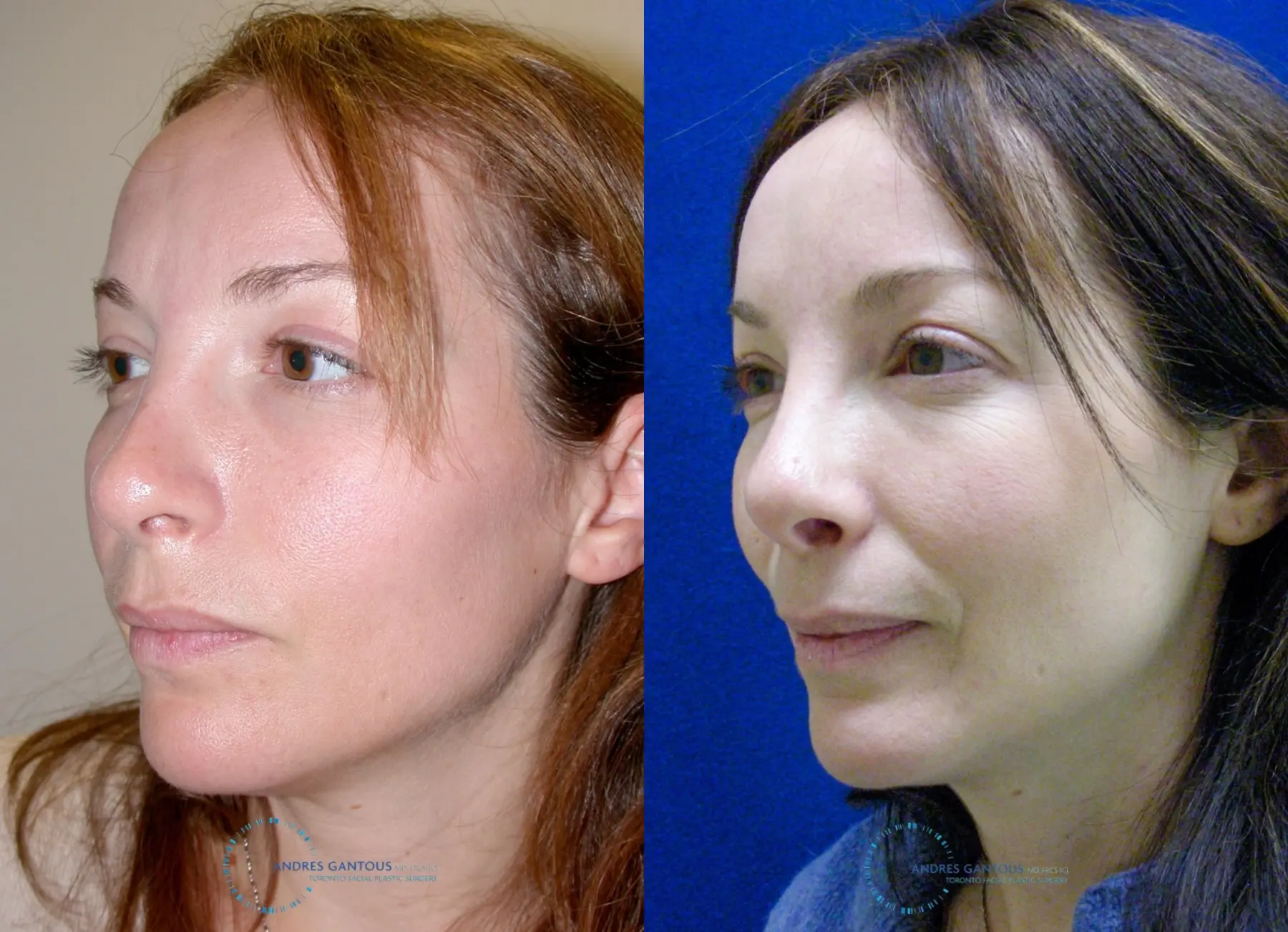 Revision Rhinoplasty: Patient 2 - Before and After 3