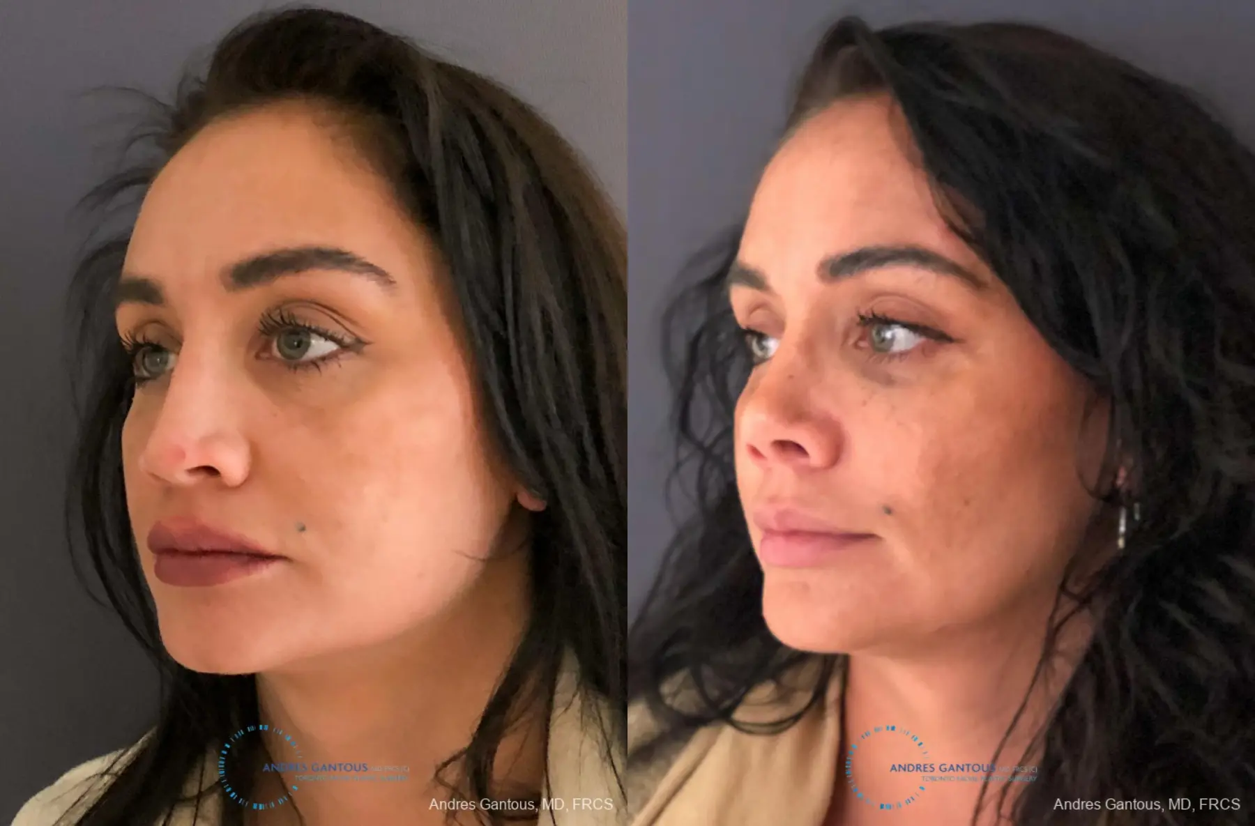 Revision Rhinoplasty: Patient 13 - Before and After 4