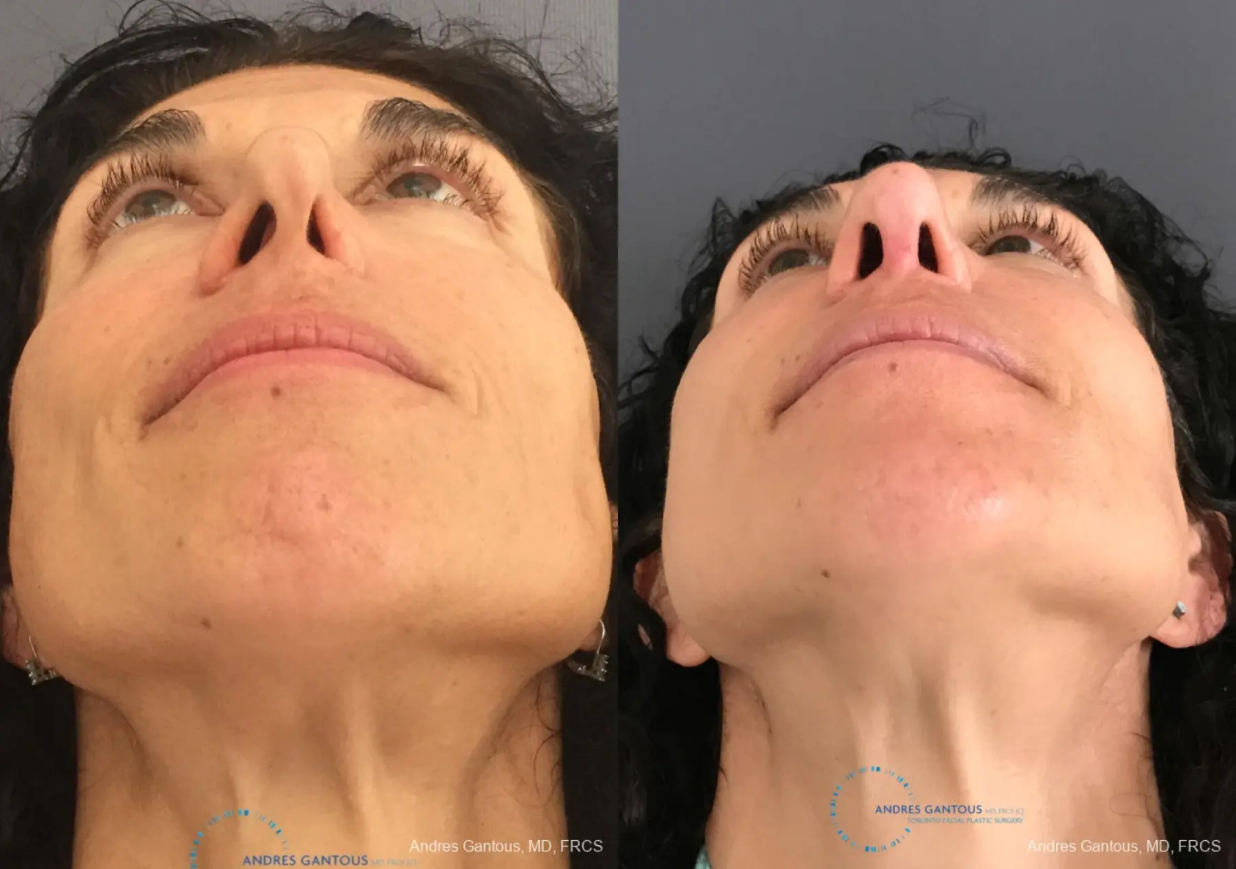 Revision Rhinoplasty: Patient 6 - Before and After 2