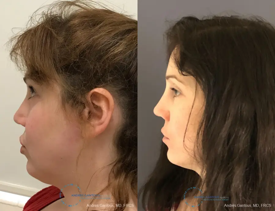 Revision Rhinoplasty: Patient 9 - Before and After 6
