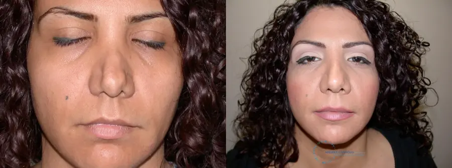 Revision Rhinoplasty: Patient 12 - Before and After 1