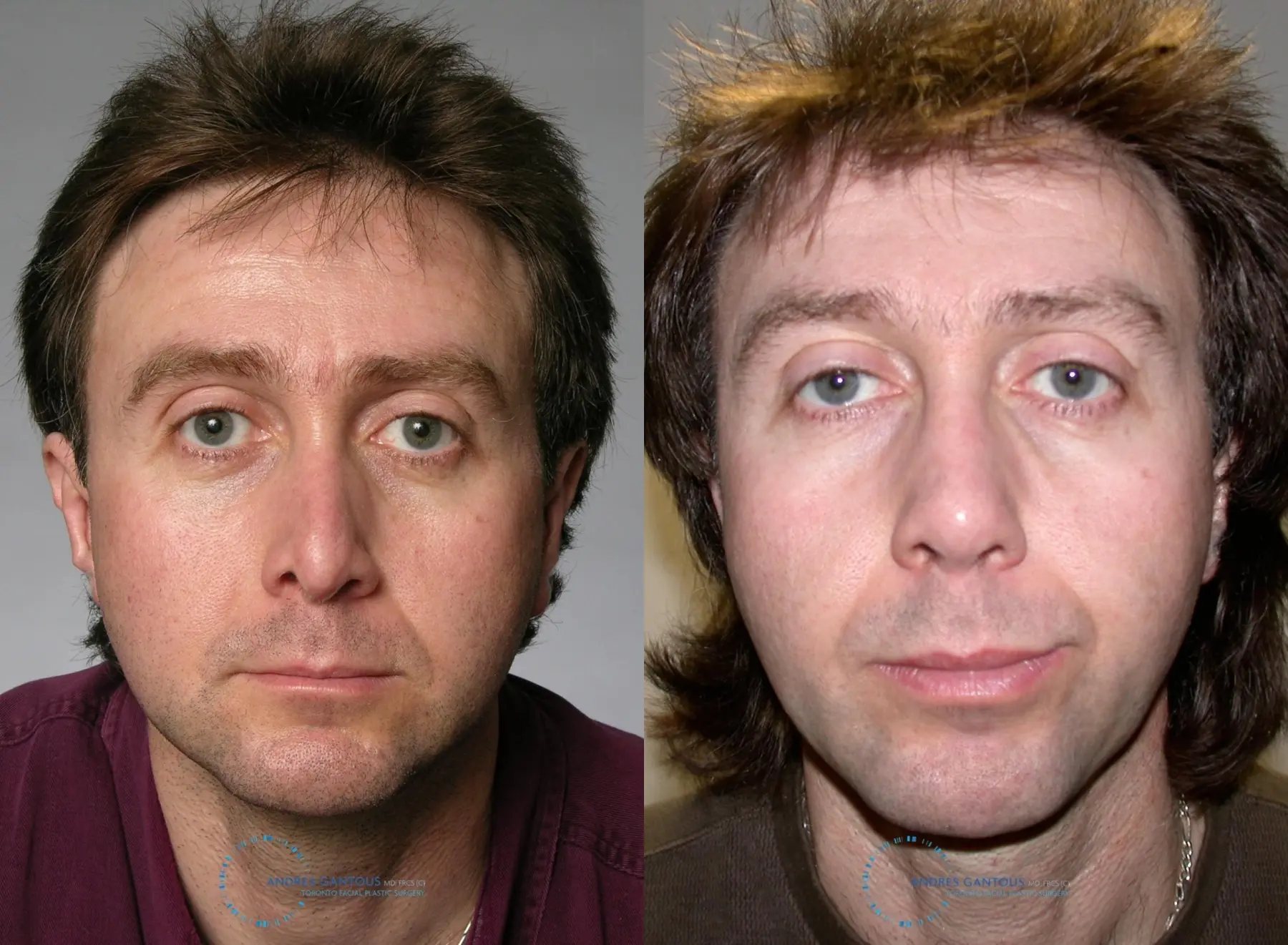 Revision Rhinoplasty: Patient 20 - Before and After  