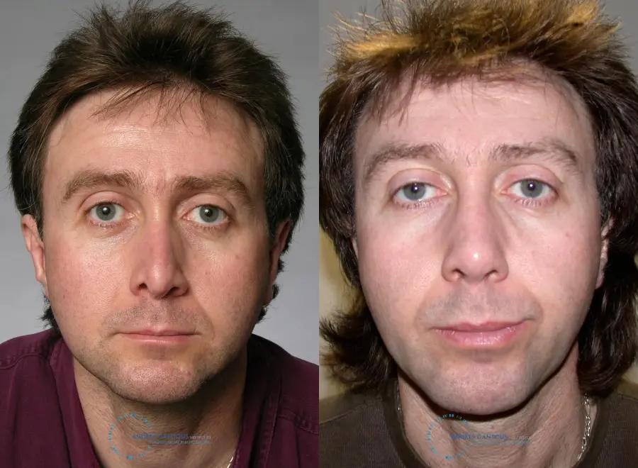 Revision Rhinoplasty: Patient 20 - Before and After 1