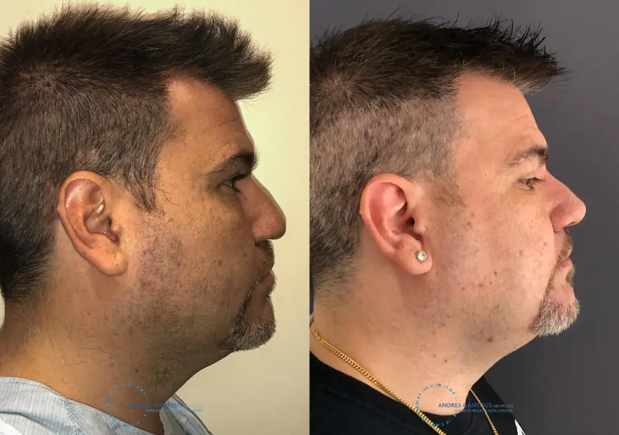 Revision Rhinoplasty: Patient 22 - Before and After 6