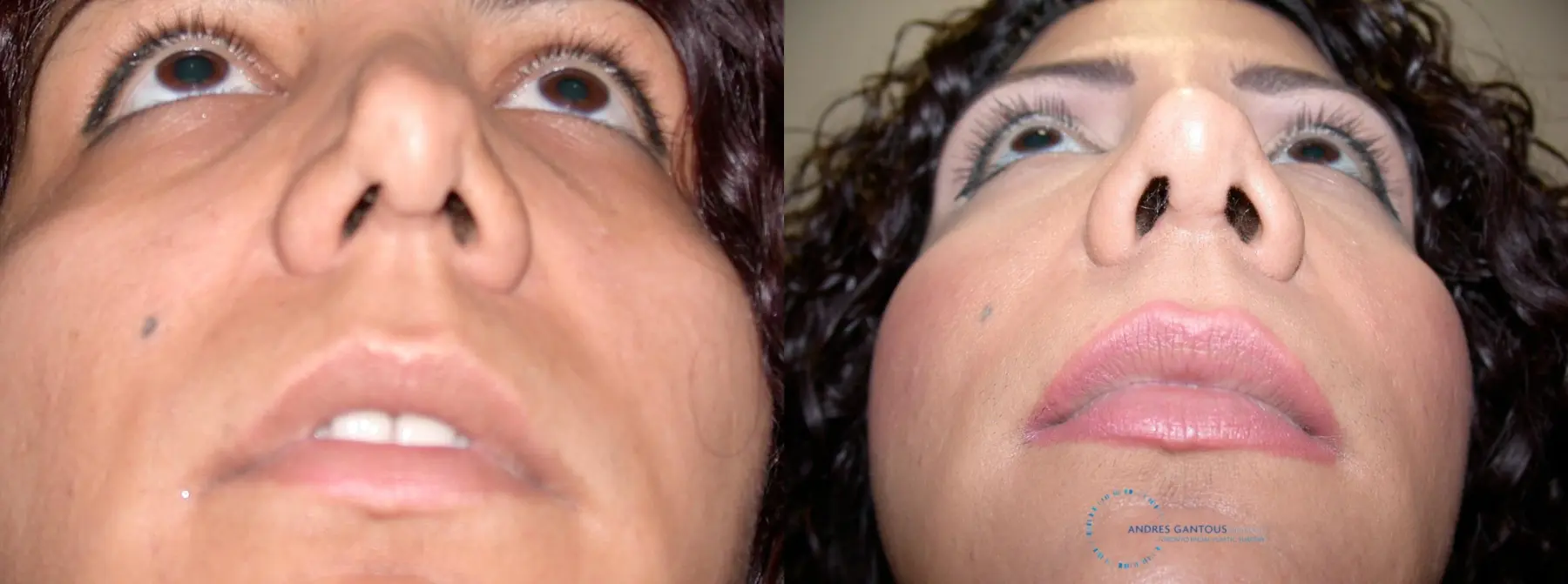 Revision Rhinoplasty: Patient 12 - Before and After 2