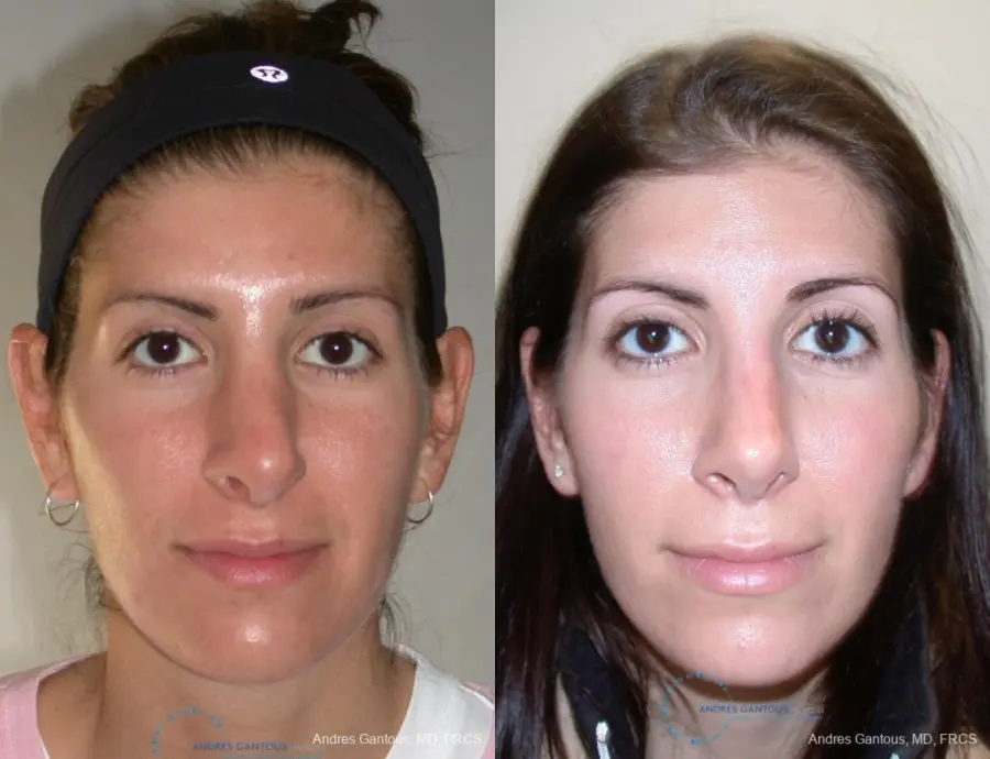 Revision Rhinoplasty: Patient 1 - Before and After 1
