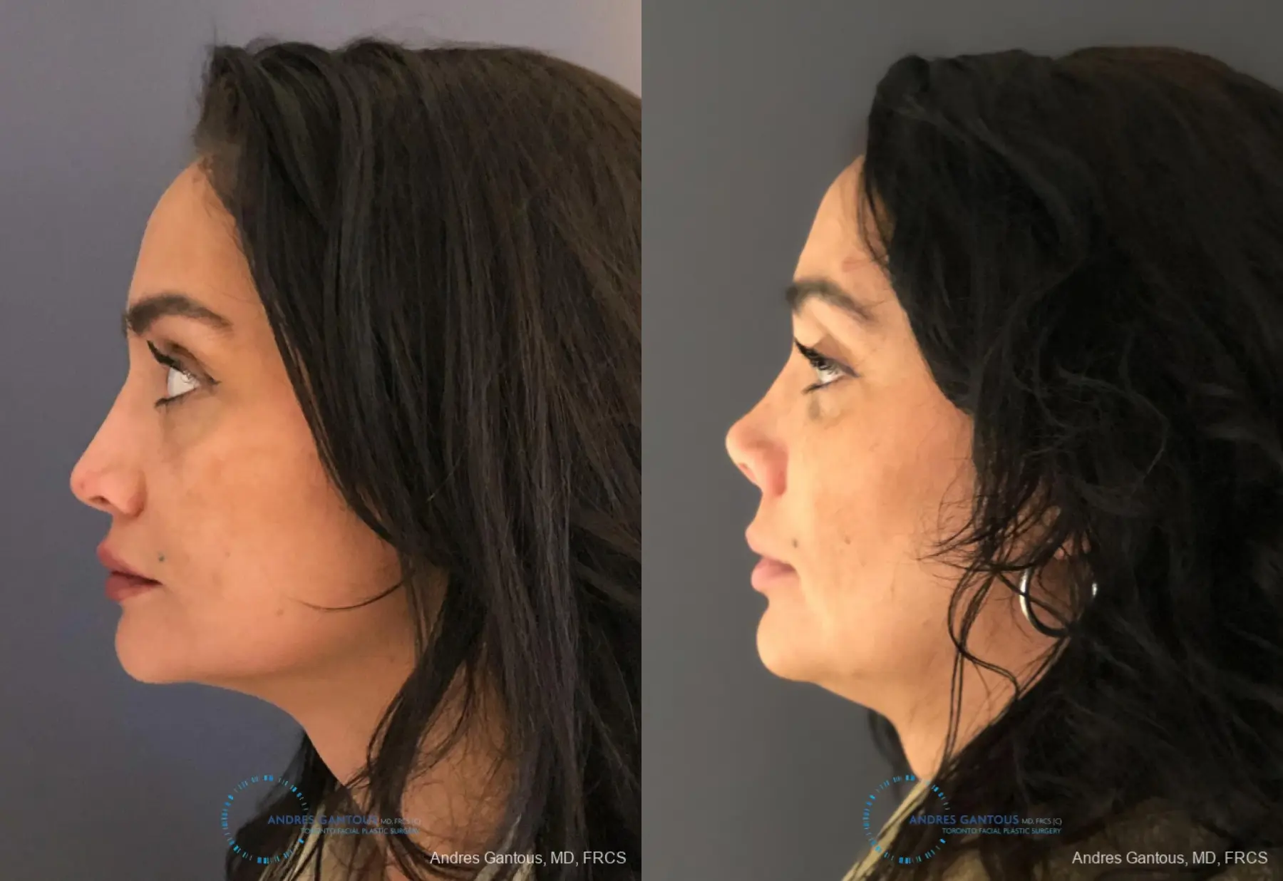 Revision Rhinoplasty: Patient 13 - Before and After 6