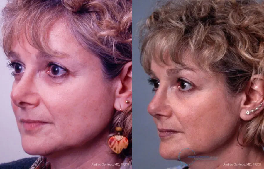 Revision Rhinoplasty: Patient 8 - Before and After 4