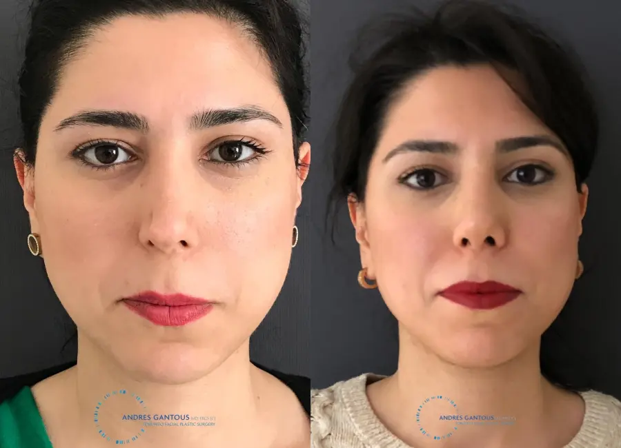 Revision Rhinoplasty: Patient 18 - Before and After 1