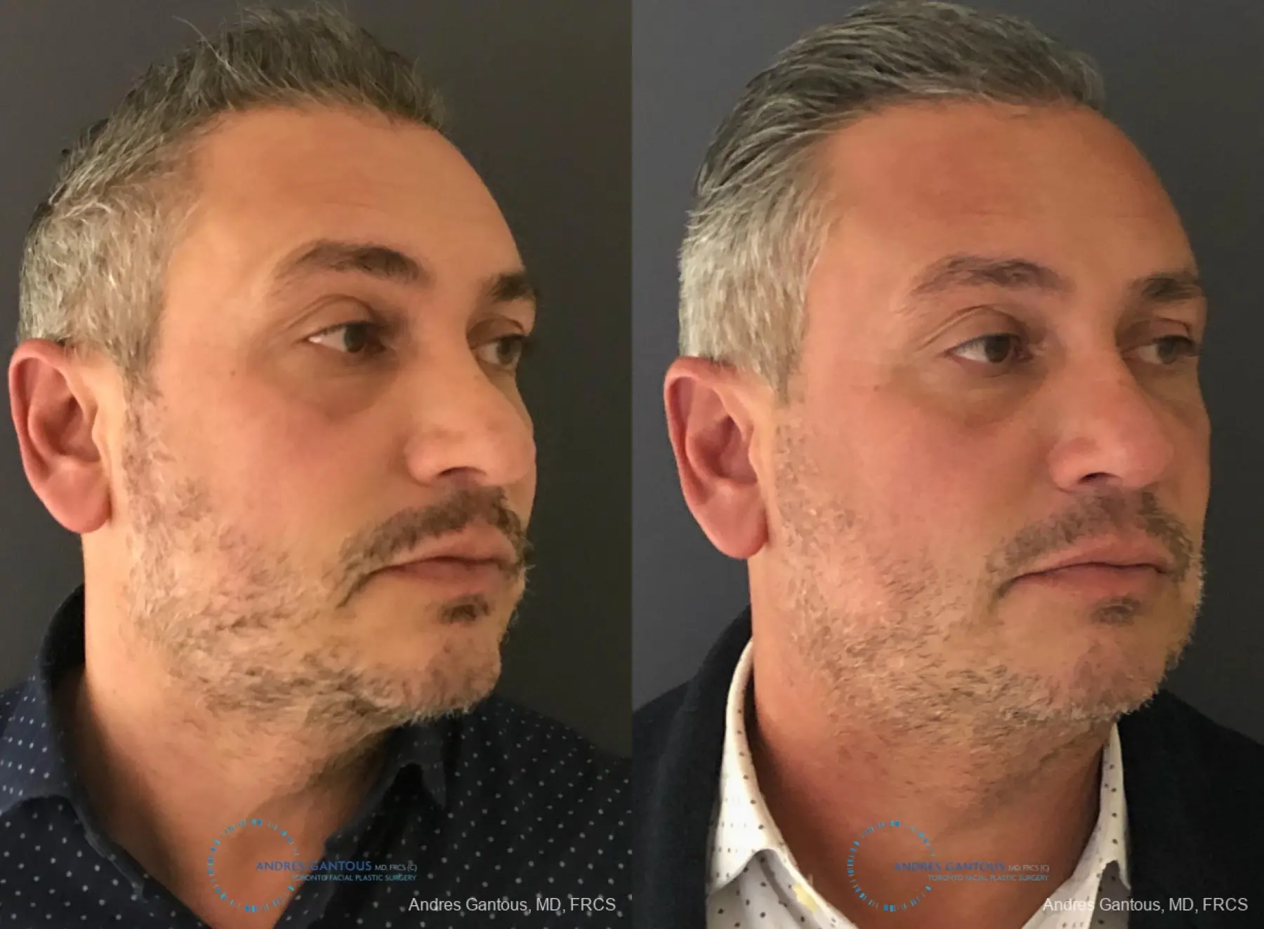 Revision Rhinoplasty: Patient 7 - Before and After 3