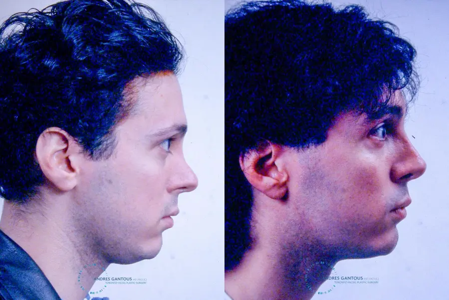 Revision Rhinoplasty: Patient 4 - Before and After 4