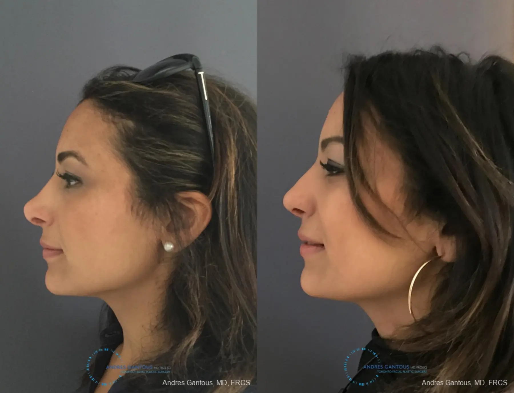 Revision Rhinoplasty: Patient 11 - Before and After 6
