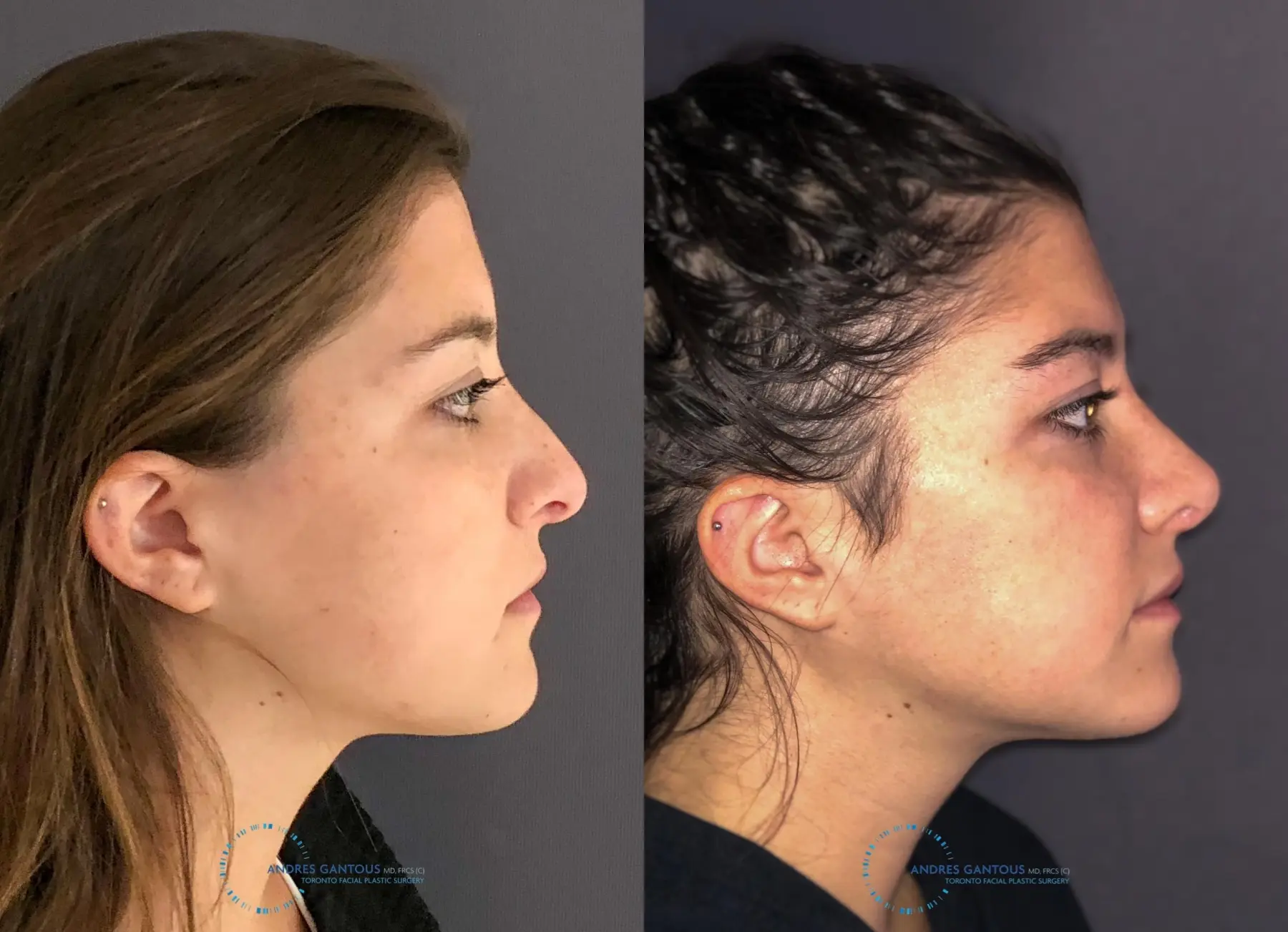Revision Rhinoplasty: Patient 21 - Before and After 6